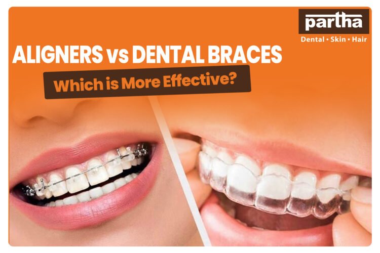 Aligners vs Dental Braces