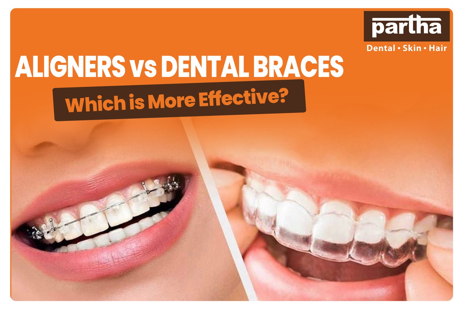 Aligners vs Dental Braces scaled