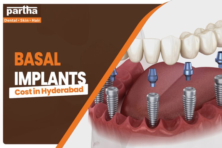 Basal implants cost in hyd