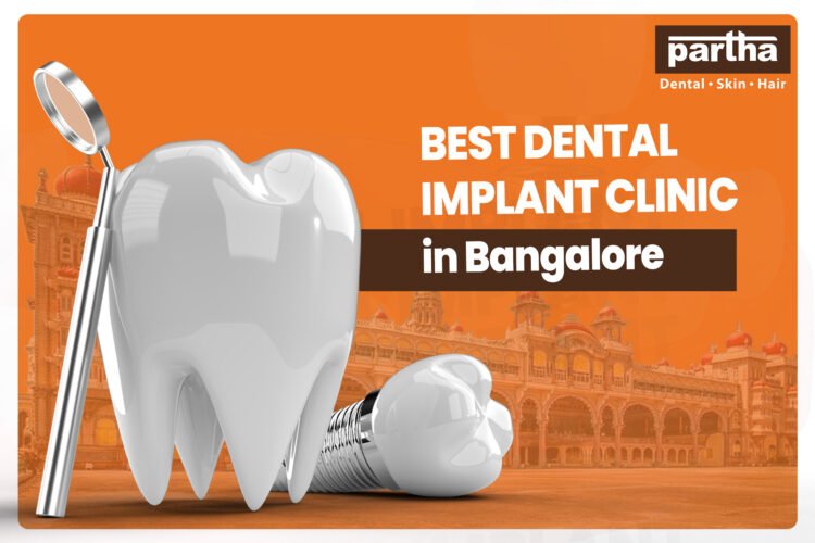 Best Dental implants in bengalore
