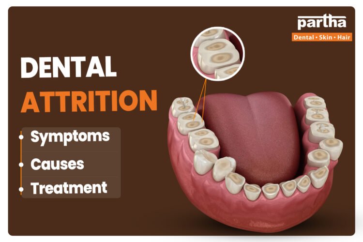 Dental attrition