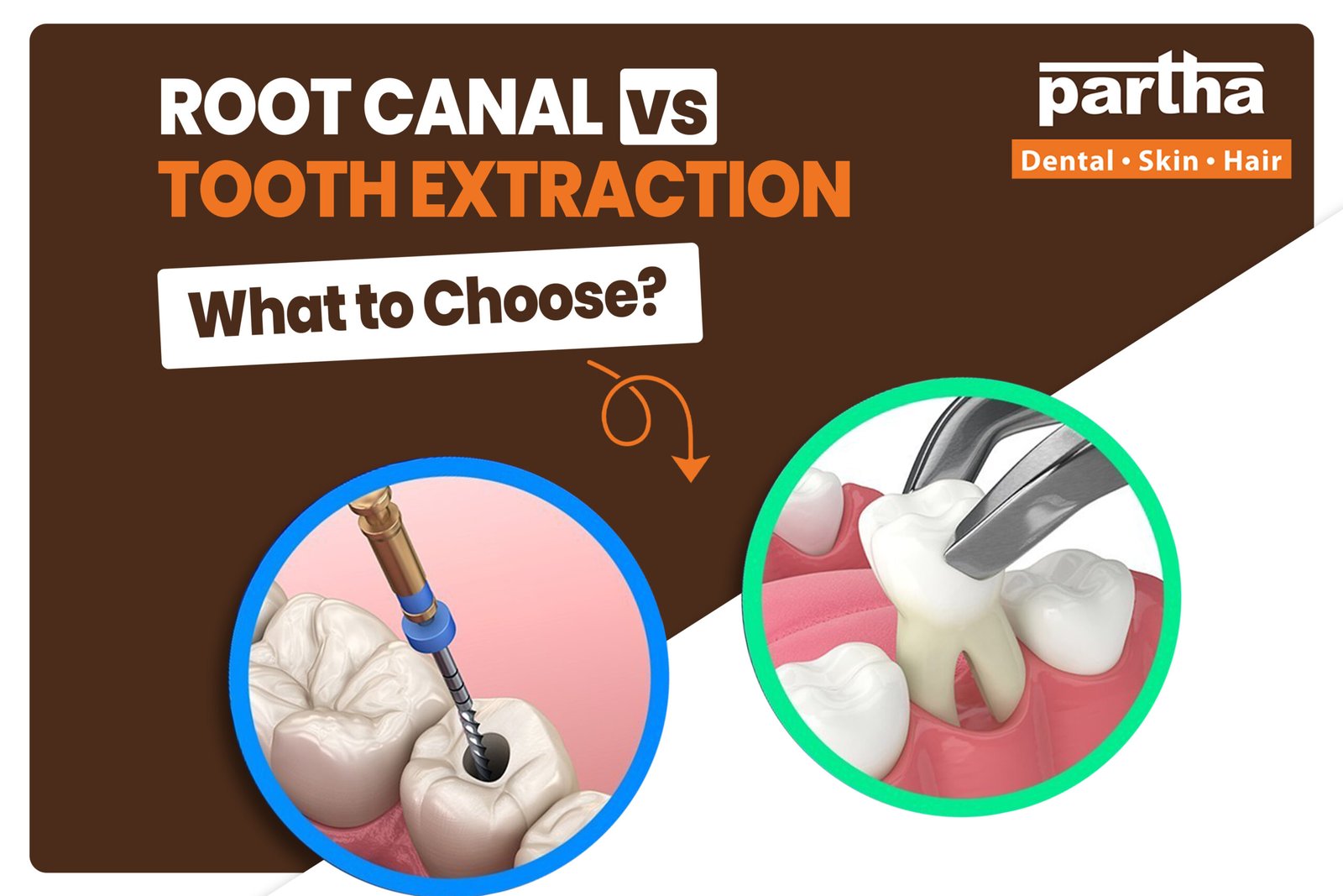 Root Canal vs tooth Extraction scaled
