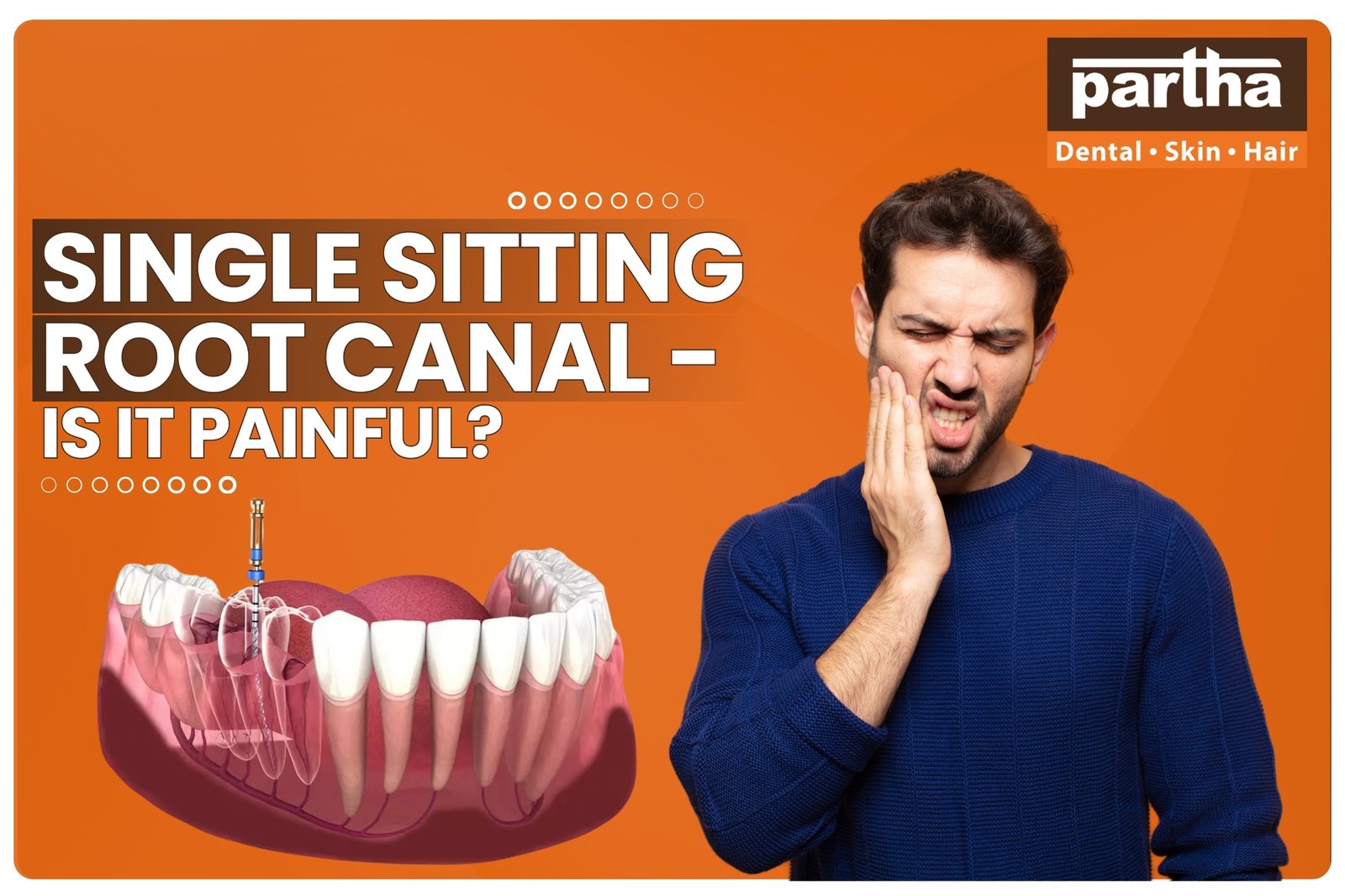 single sitting root canal