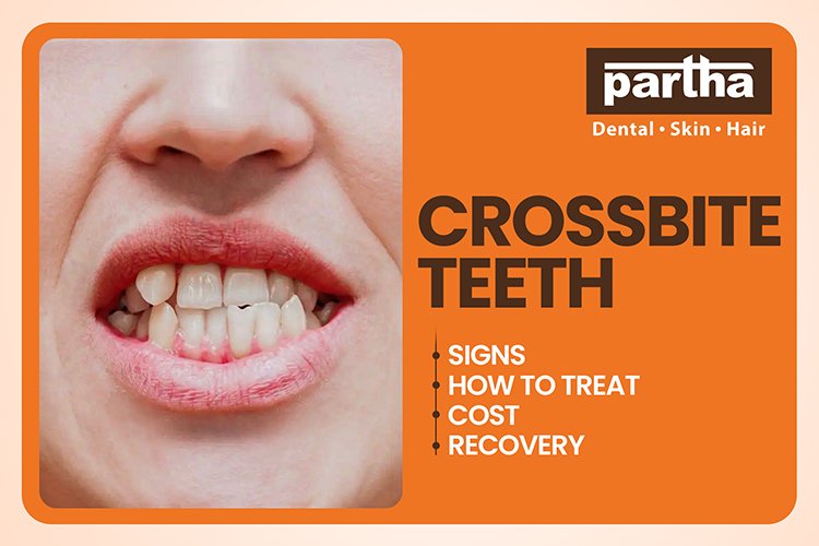 crossbite teeth 1
