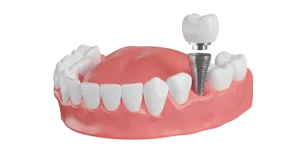 same day dental implants
