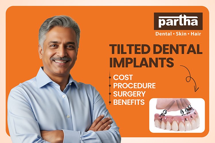 tilted dental implants