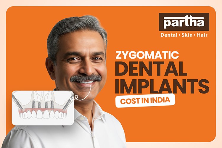 zygomatic implants
