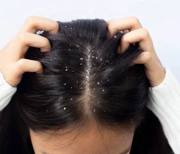 Anti Dandruff Treatment 1