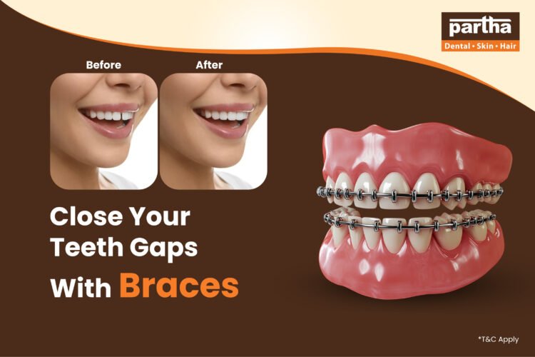 Close Your Teeth Gaps With Braces