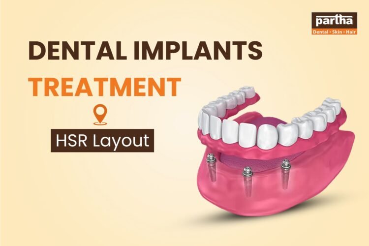 Dental Implants Treatment in HSR layout