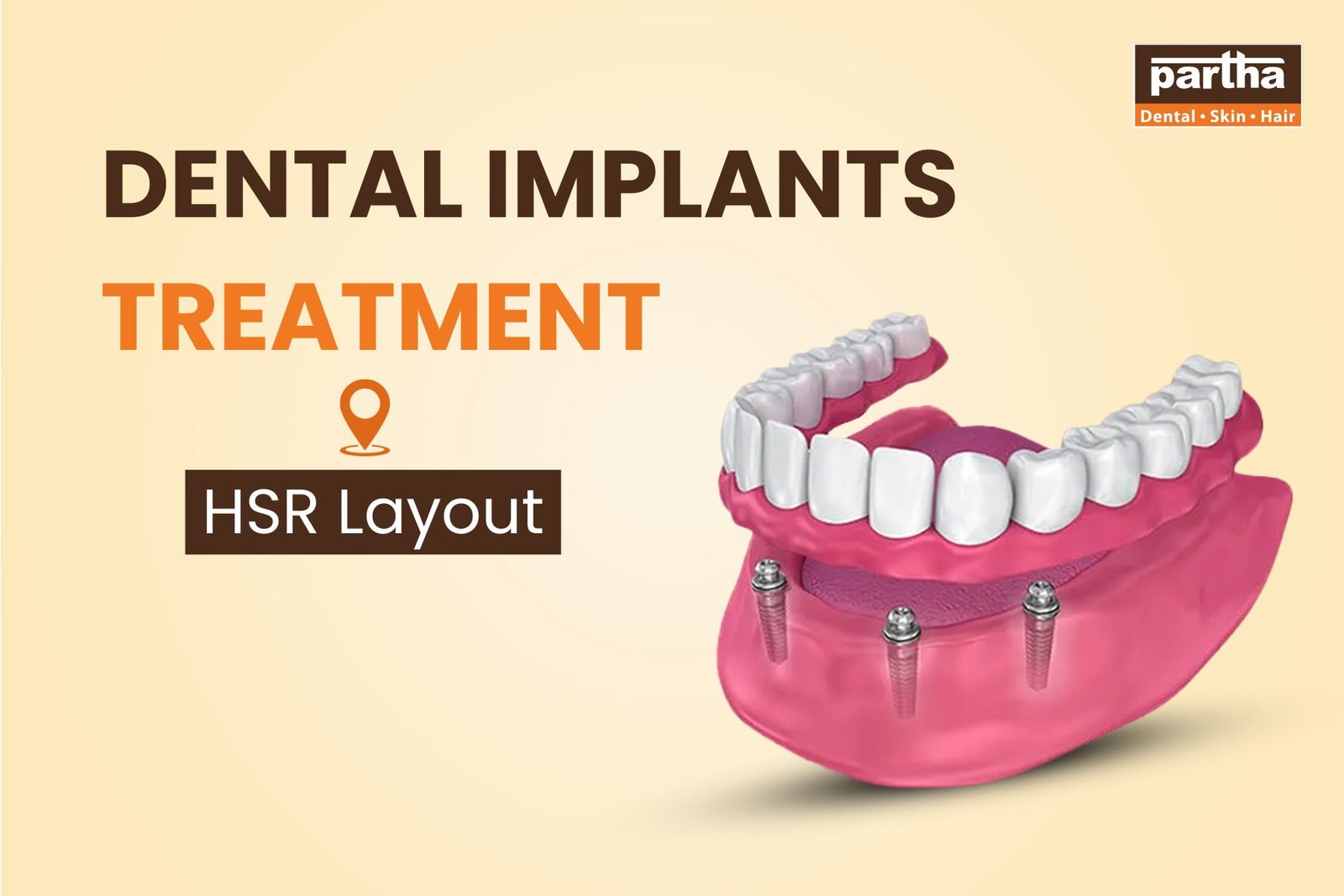 Dental Implants Treatment in HSR layout