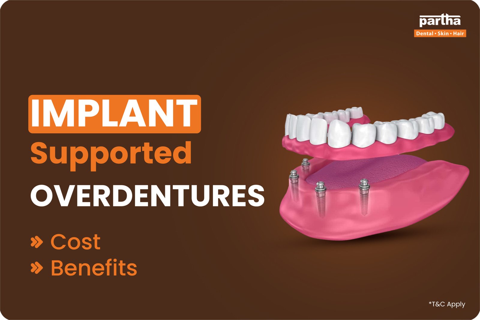 Implant Supported Overdentures 2 scaled
