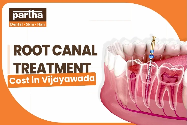 root canal treatment in ameerept