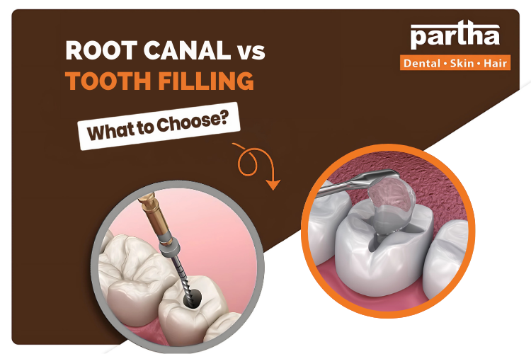 RCT vs Filling 1