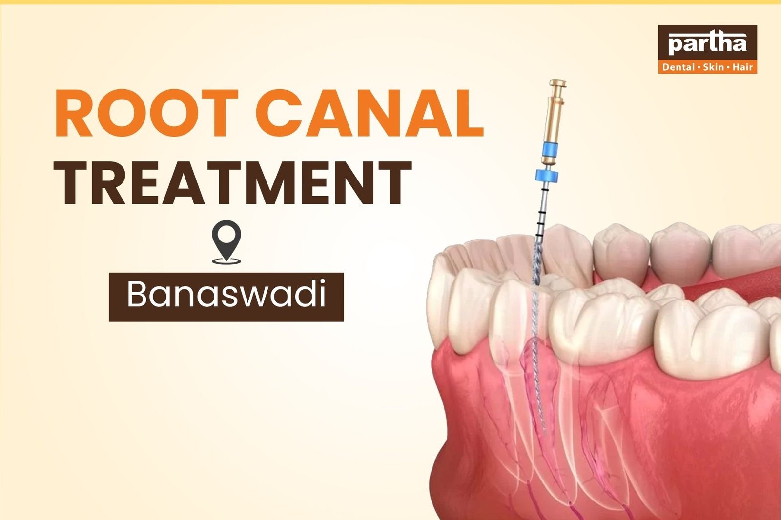 Root Canal Treatment Banaswadi