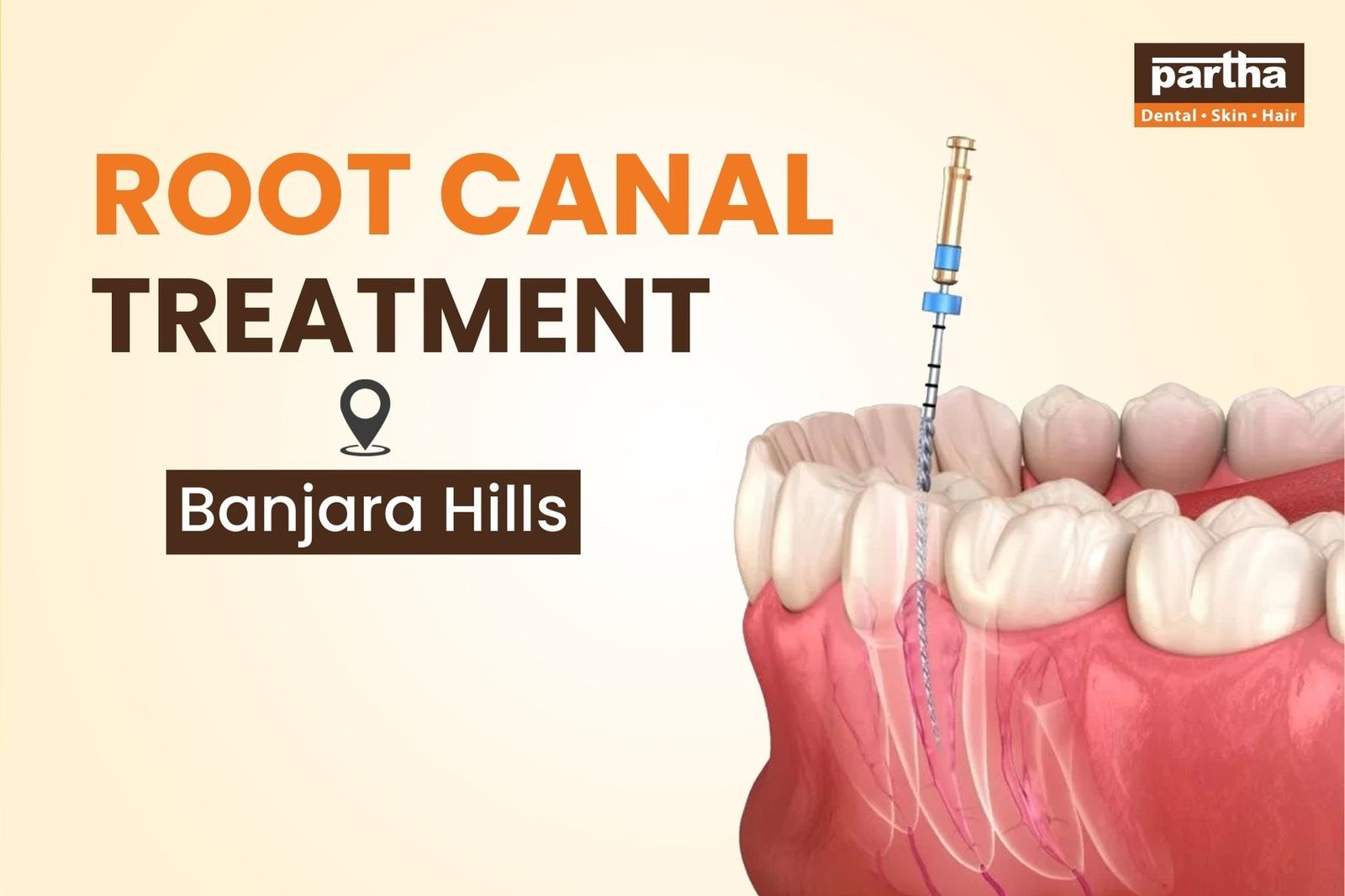 Root Canal Treatment in Banjara Hills