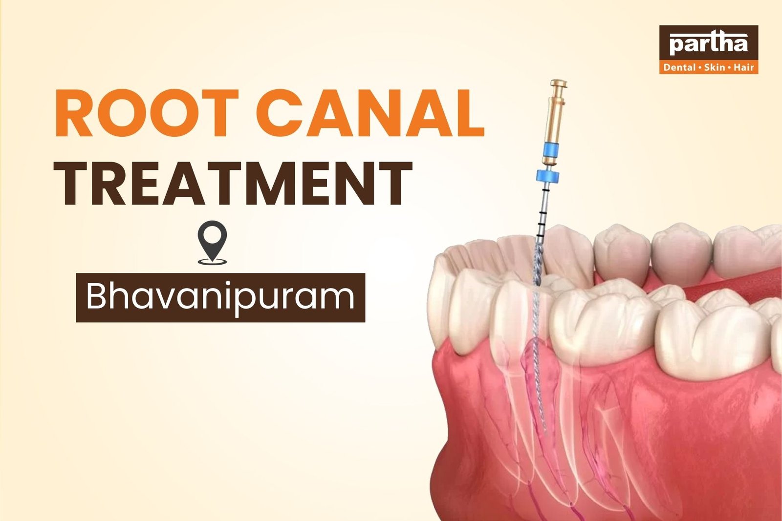 Root Canal Treatment in Bhavanipuram