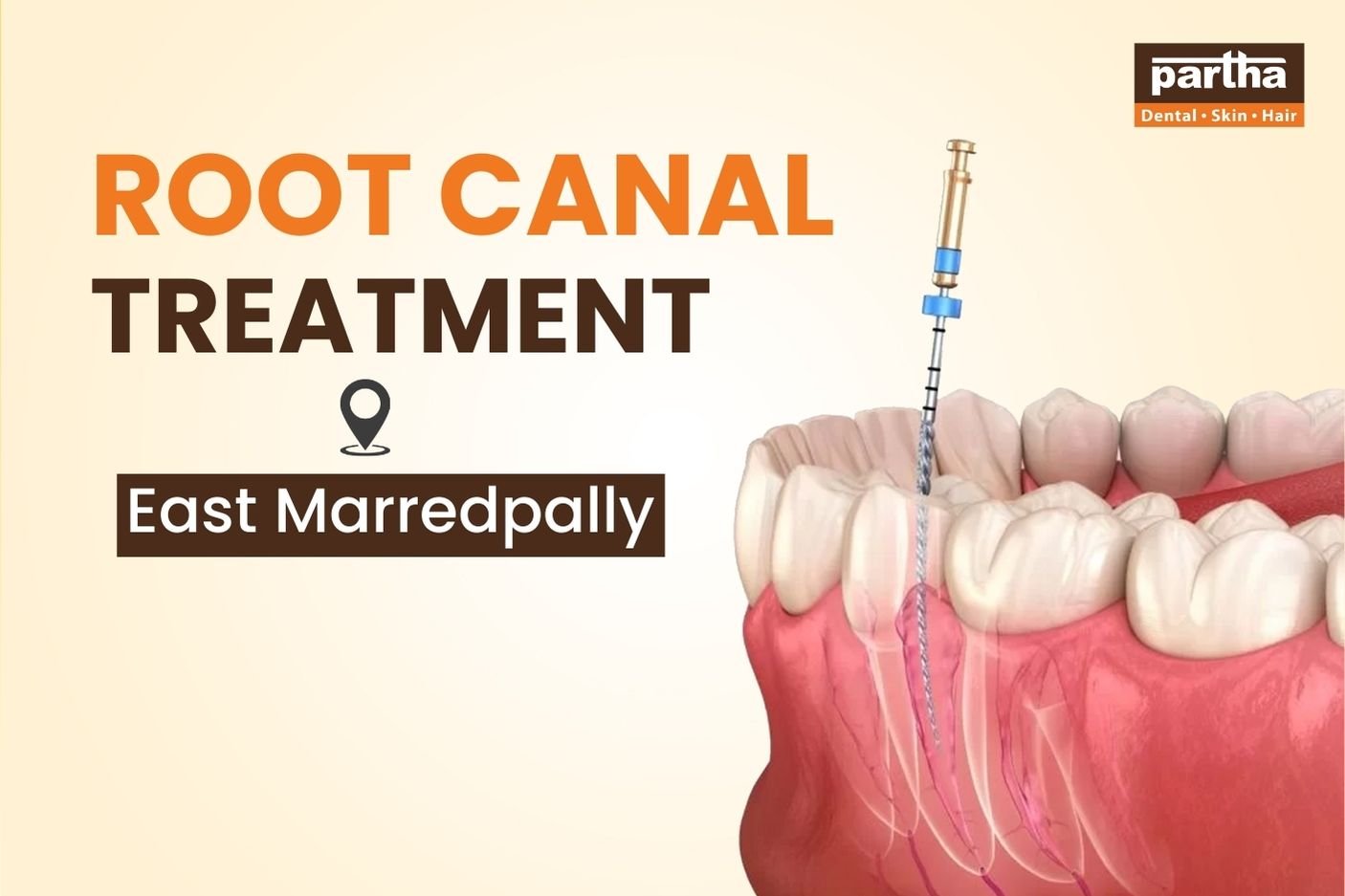 Root Canal Treatment in East Marredpally