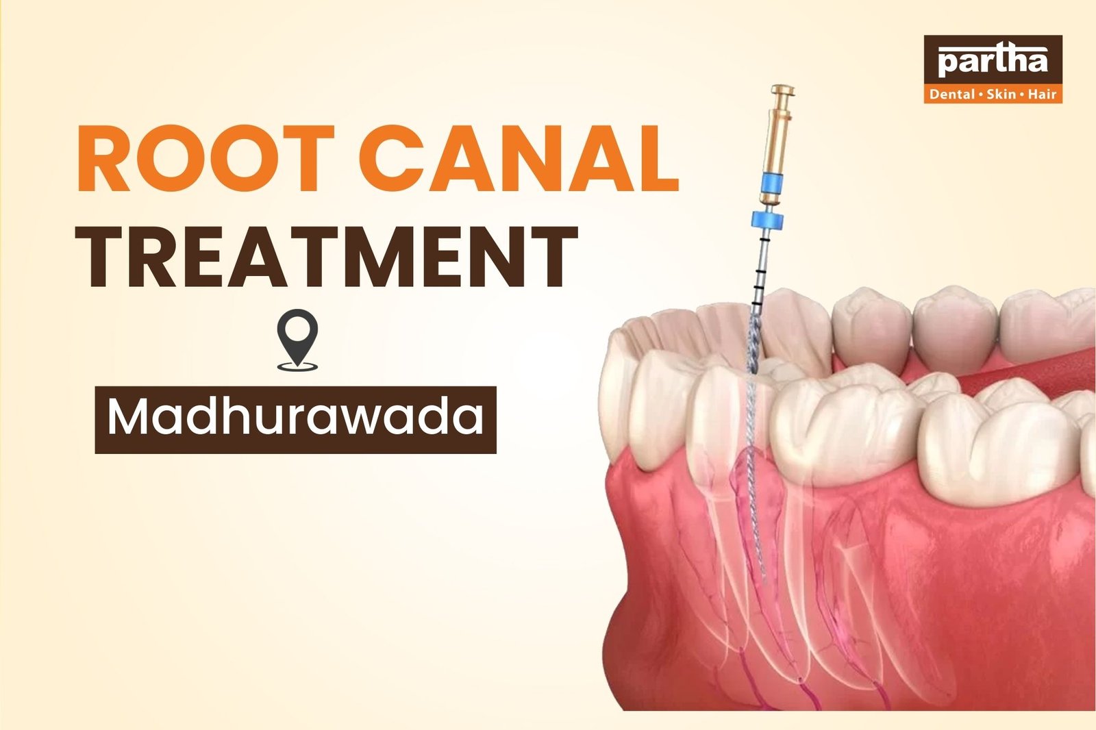 Root Canal Treatment in Madhurawada