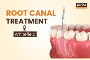Root canal Treatment Whitefild.