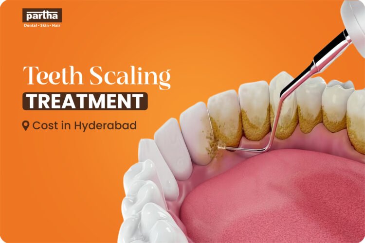 Teeth Scaling Treatment Cost in Hyderabad