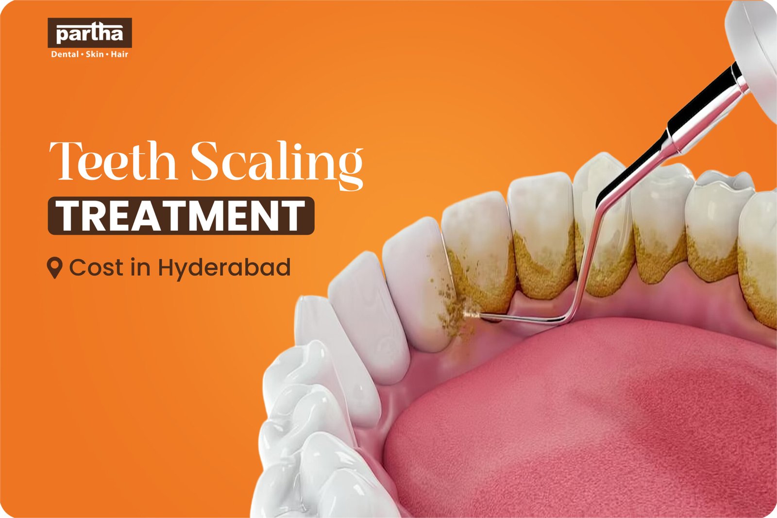 Teeth Scaling Treatment Cost in Hyderabad scaled