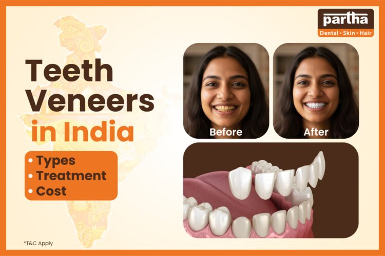 teeth veneers cost in india