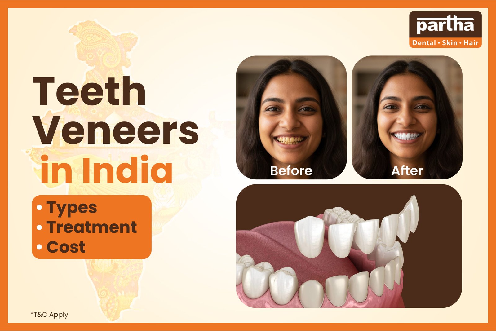 teeth veneers cost in india
