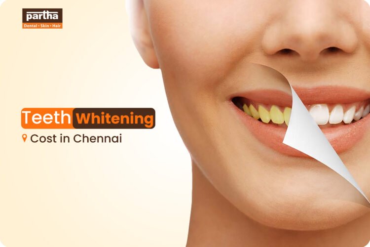 Teeth Whitening Cost in Chennai