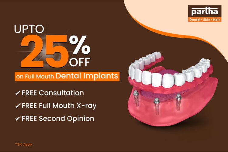 Up to 25% off on Full Mouth dental implants