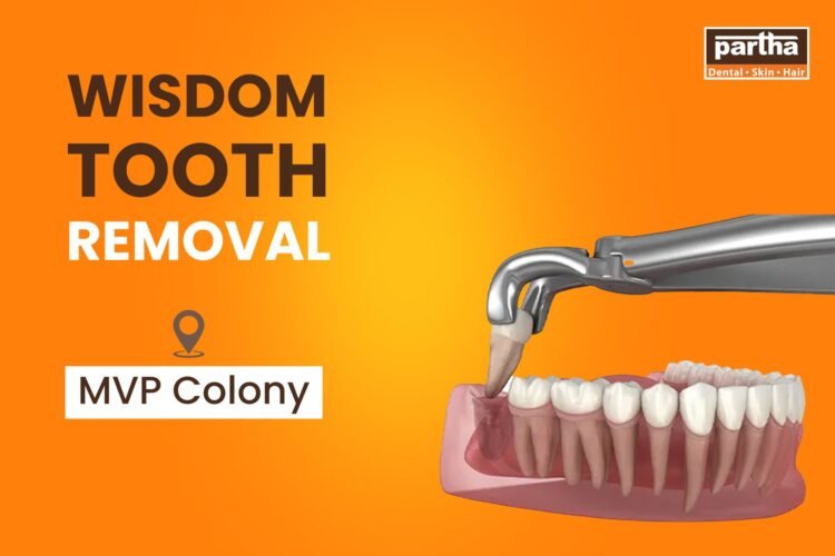 Wisdom tooth removal MVP Colony
