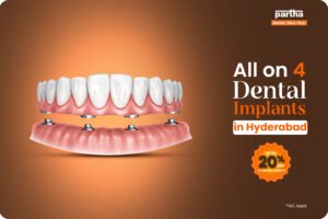 All on 4 Dental Implants in Hyderabad