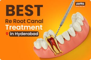 best re root canal treatment hyderabad