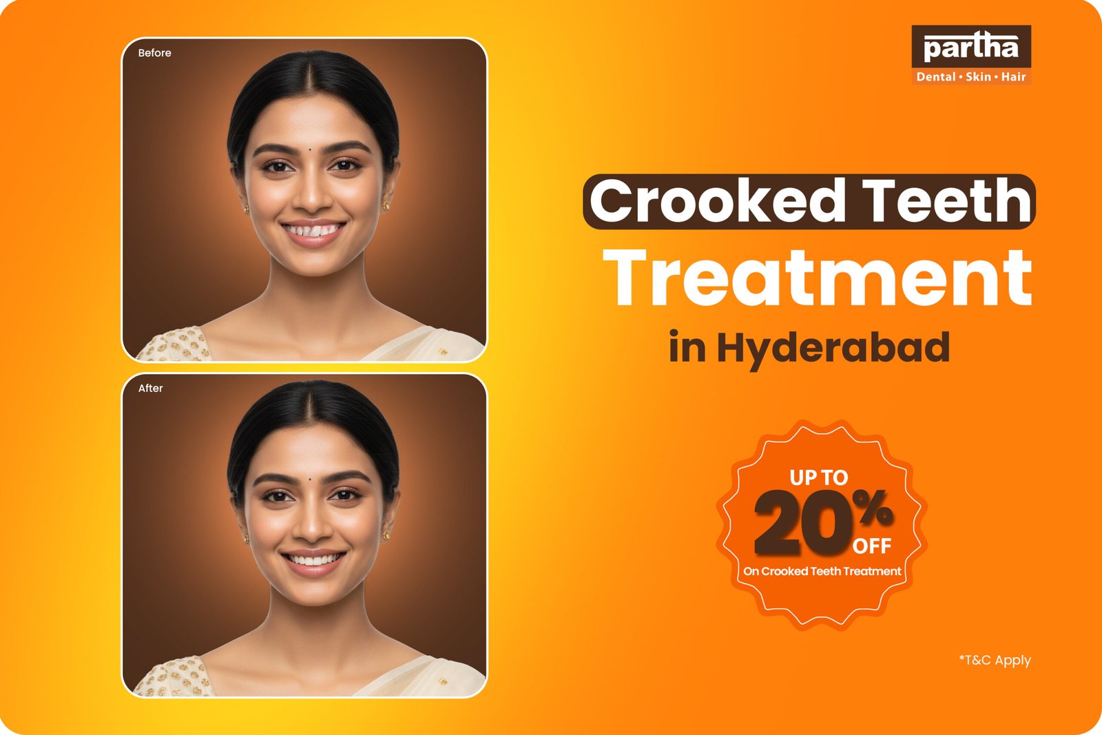 Crooked Teeth Treatment in Chennai – Cost, Types & Treatment 1 Crooked Teeth Treatment in Chennai 1 scaled