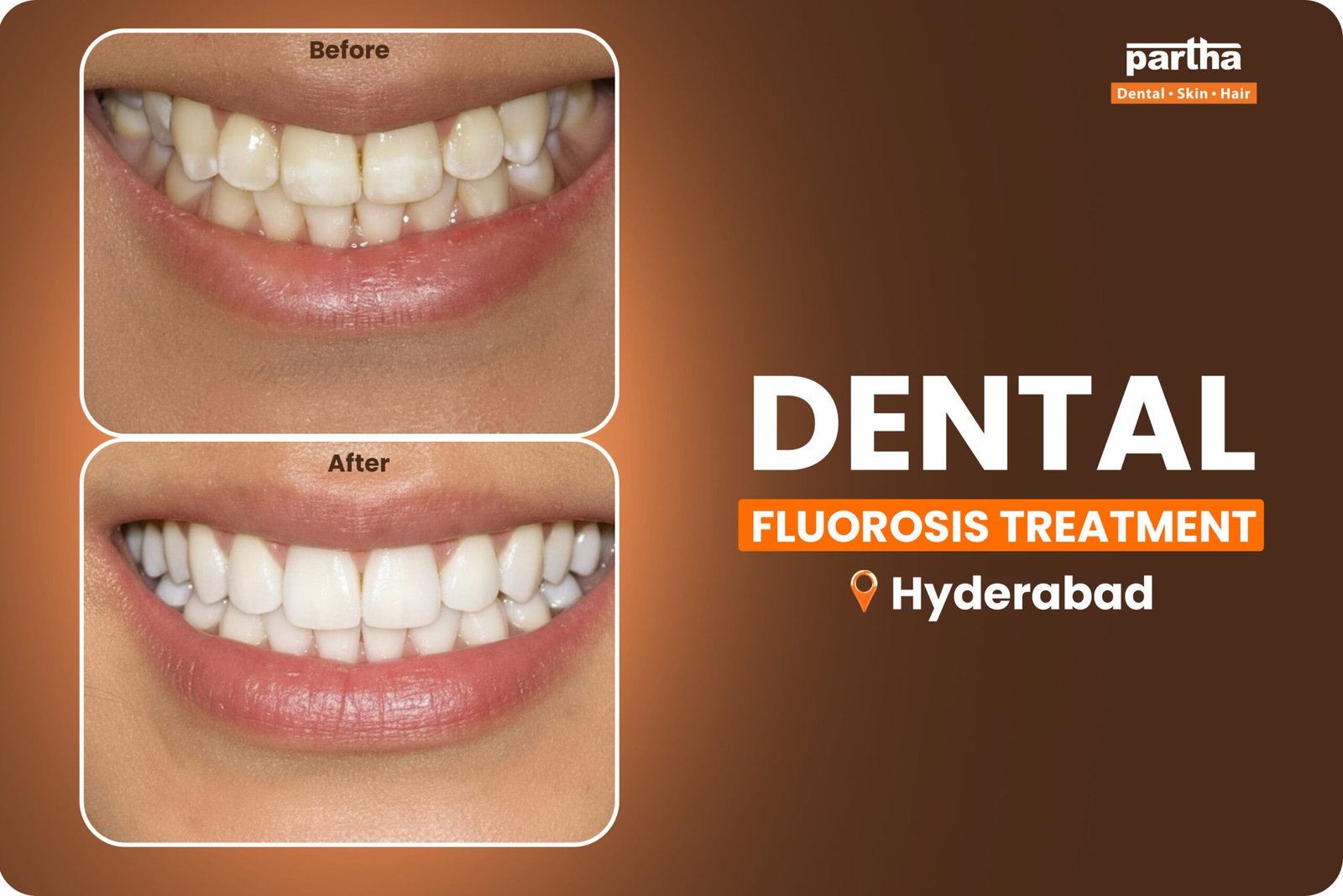 Dental Fluorosis Treatment In Hyderabad