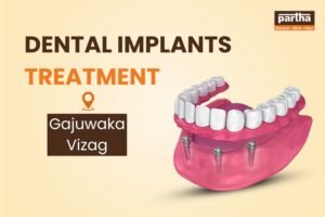 Attachment Details Dental Implants in Gajuwaka Junction