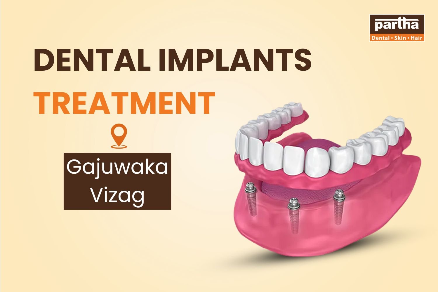 Attachment Details Dental Implants in Gajuwaka Junction