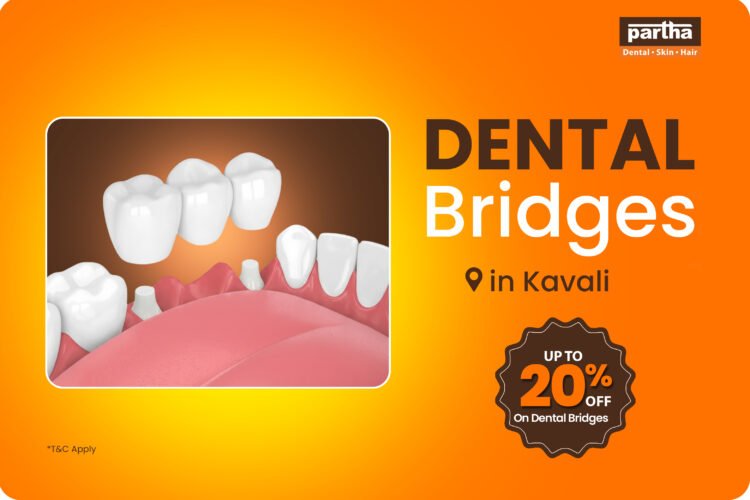 Missing Teeth? Restore Your Smile with the Best Dental Bridges in Kavali – Up to 20% Off at Partha Dental Clinic! 1 Dental-bridges-Kavali