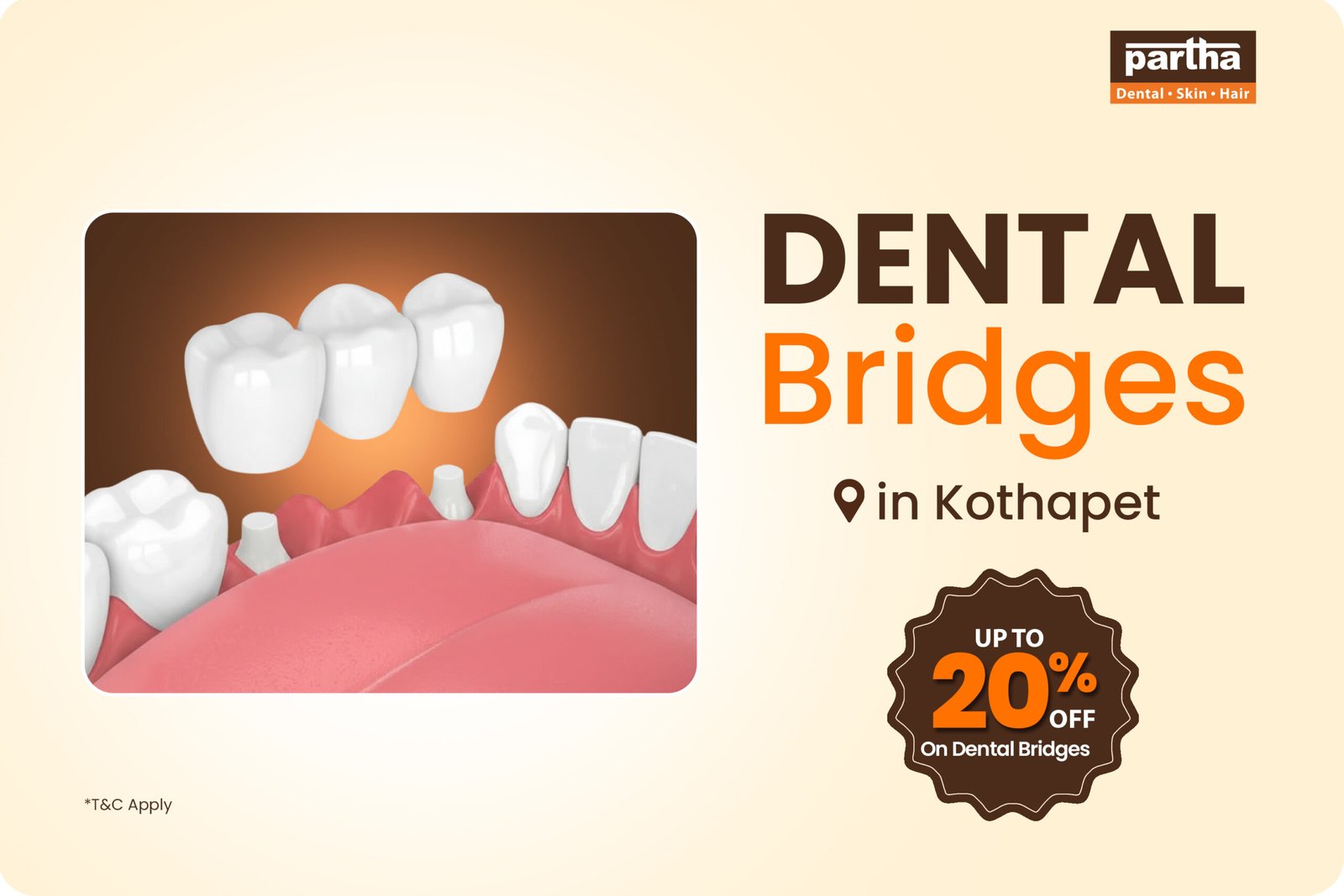 Dental Bridges Treatment in Kothapet – Replace Your Missing Teeth with Partha Dental and get up to 20% off 1 dental-briges-treatment-kothapet