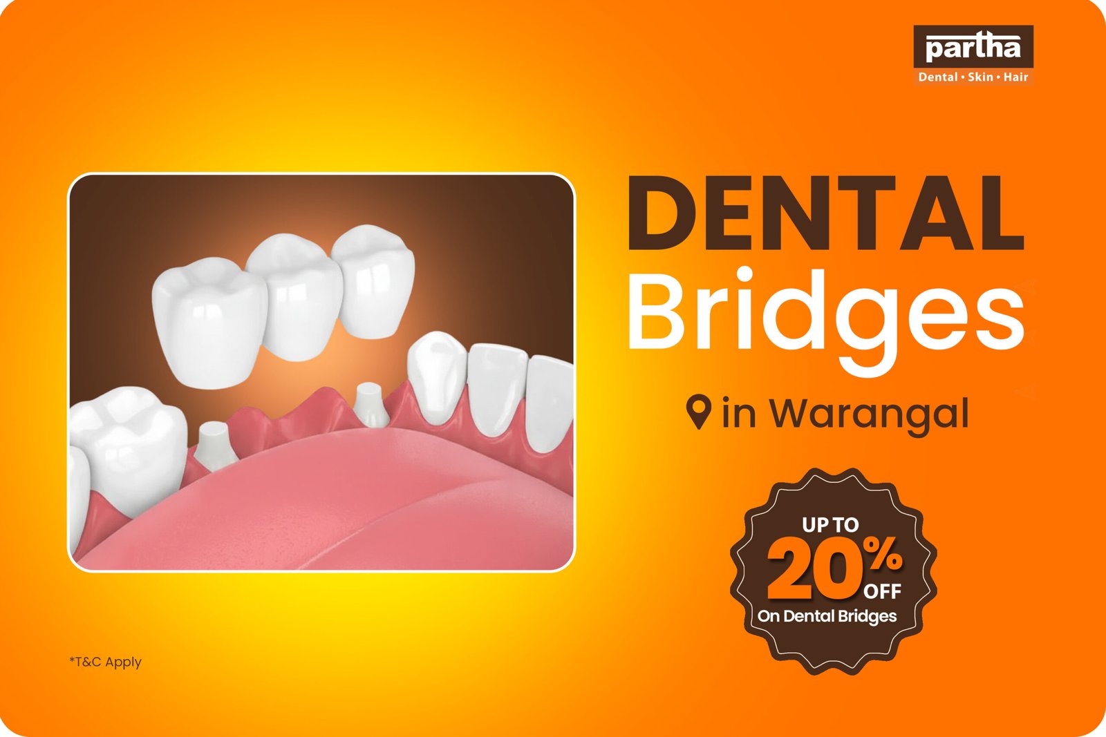 Dental Bridges Treatment in Warangal – Up to 20% OFF at Partha Dental 1 Dental Brdiges in Warangal