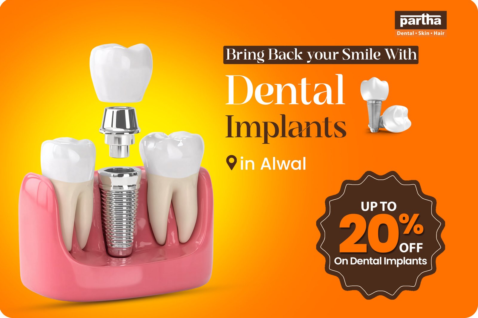 Dental Implants in Alwal – Get 20% Off at Partha Dental 1 Dental-implants-alwal