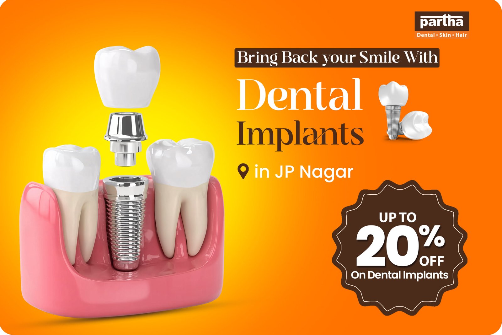 Transform Your Smile Dental Implants in JP Nagar Starting at ₹19,999 Only! 1 JP Nagar Dental Implants