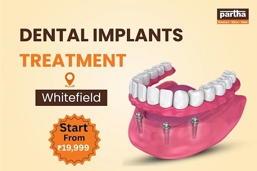 Dental-implants. Whitefield