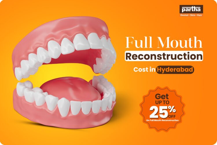 full mouth reconstruction cost in chennai
