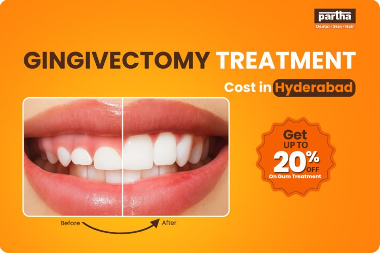 Gingivectomy Treatment Cost in Hyderabad– Get Price Estimate 1 gingivectomy treatment cost in hyderabad