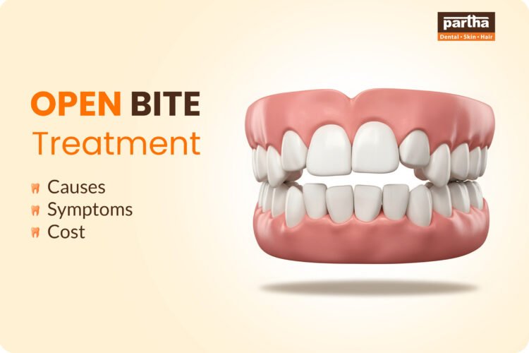 Open Bite Treatment Options