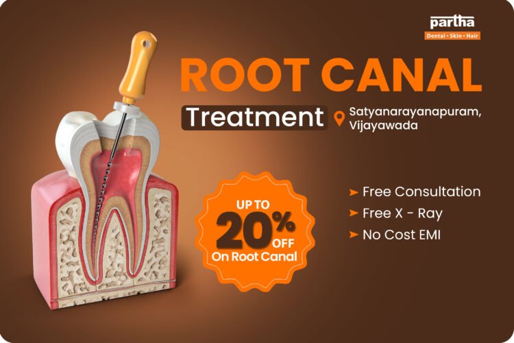 Single Visit Root Canal Treatment in Satyanarayanapuram - Up to 20% off 4 Root Canal Treatment in Satyanarayanapuram