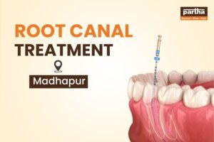 Root Canal Treatment in Madhapur