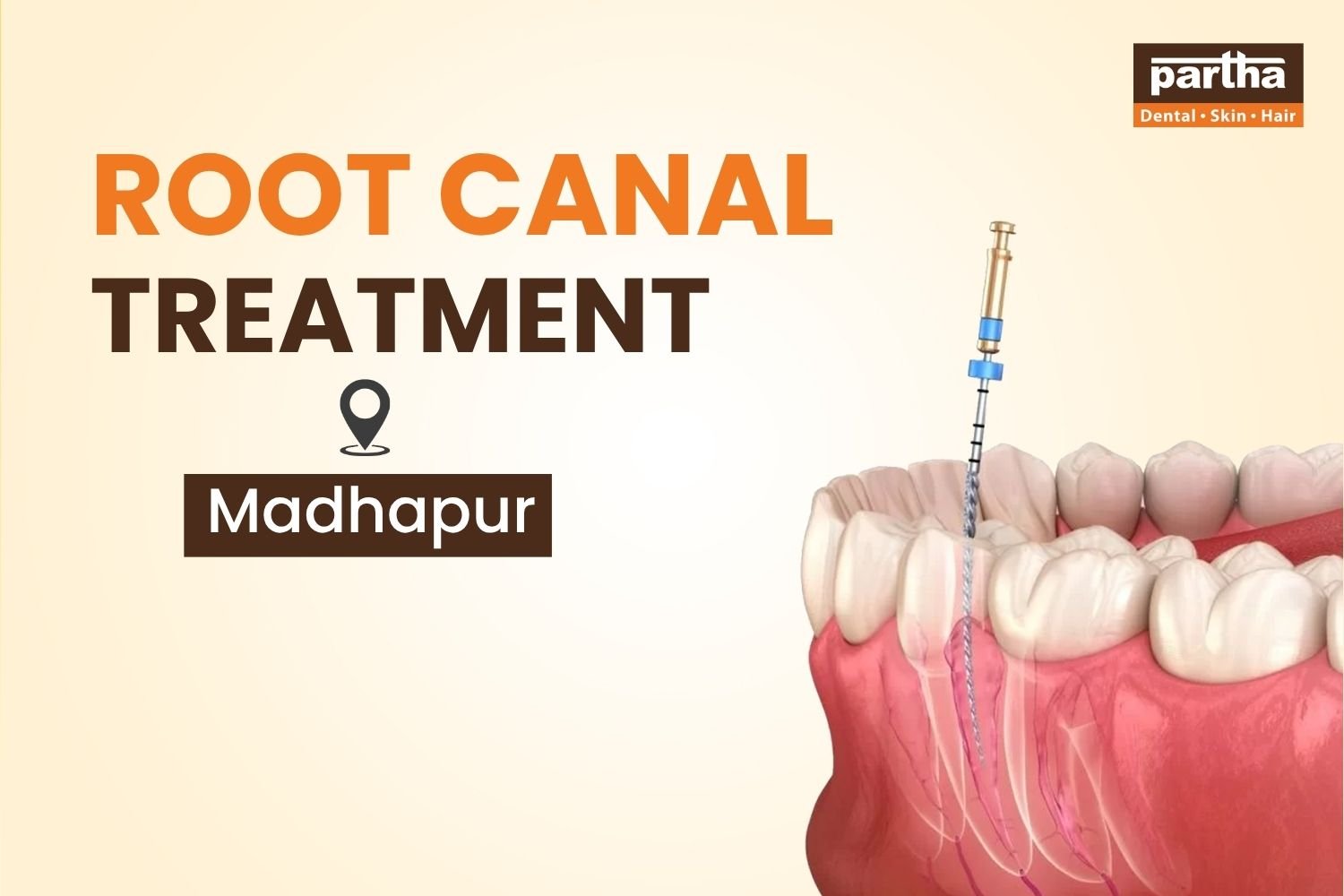 Root Canal Treatment in Madhapur