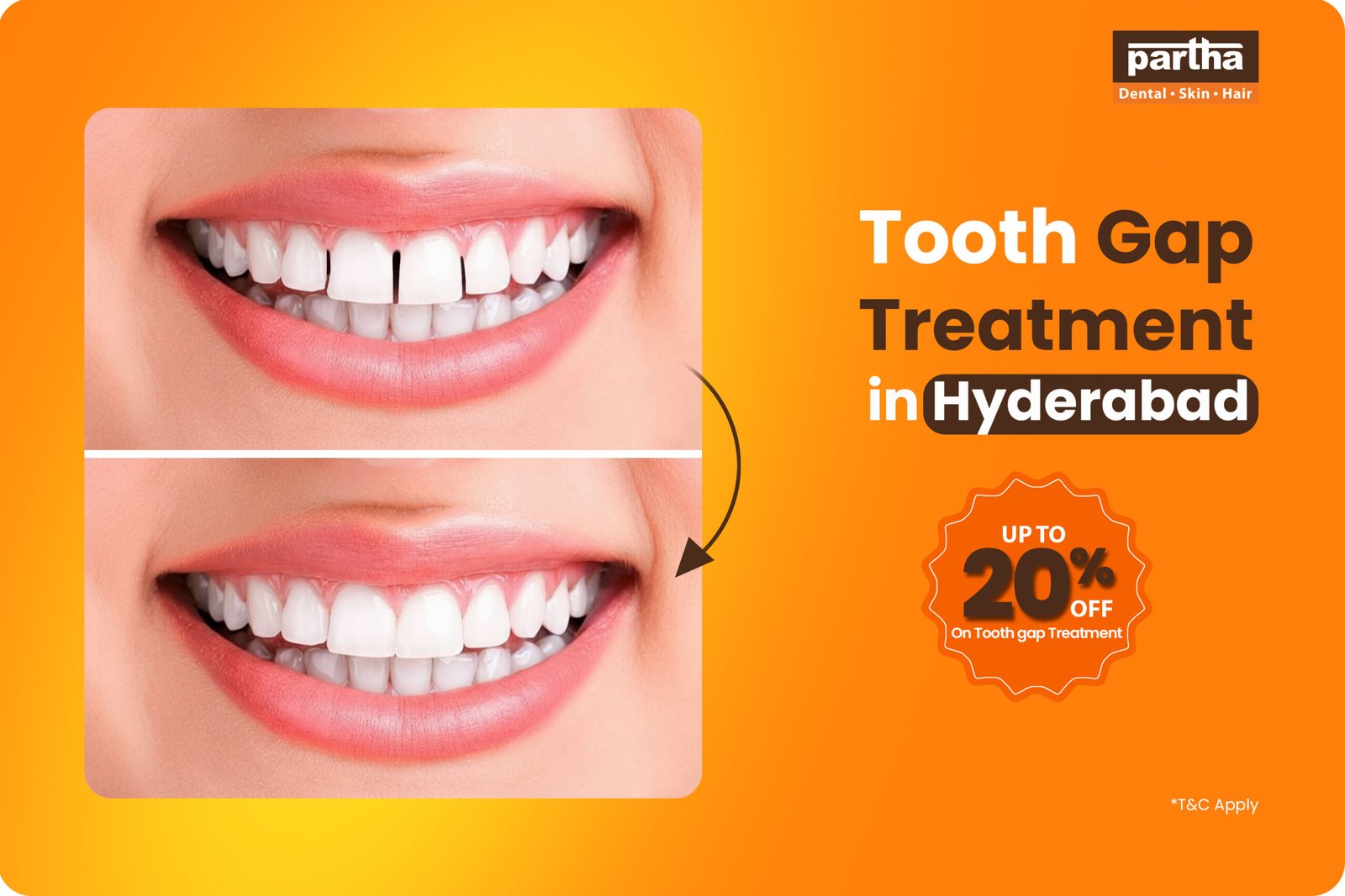 Tooth Gap Treatment in Hyderabad 1 scaled